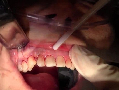 Flap Reflection And Atraumatic Extraction - Extraction #7 With Socket Grafting