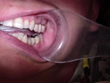 Bridge Insert: Porcelain Contour Adjustment