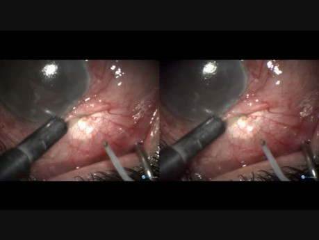 VR Surgery Case, Microtrack Filtration