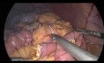 Sleeve Gastrectomy with Proximal Transit Bipartition