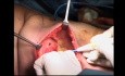 Surgery for Breast Cancer - Skin Sparing Mastectomy and LD Flap