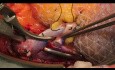 Mini Incision Kidney Transplantation