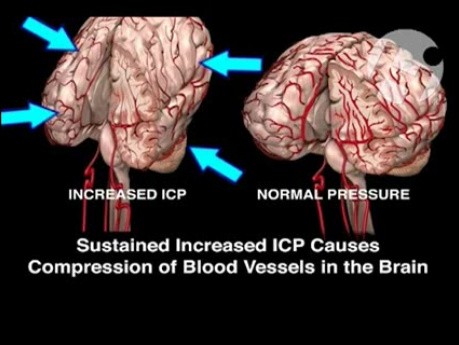 Abnormally Increased ICP in the Fetal Brain