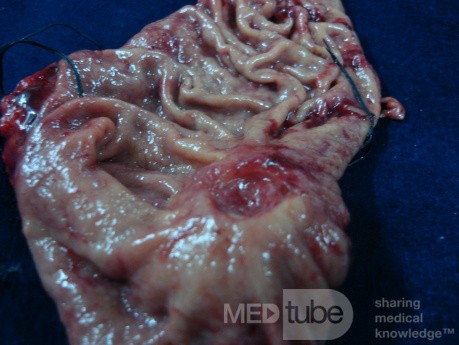 Diffuse Adenocarcinoma with signet ring cells (5 of 18)