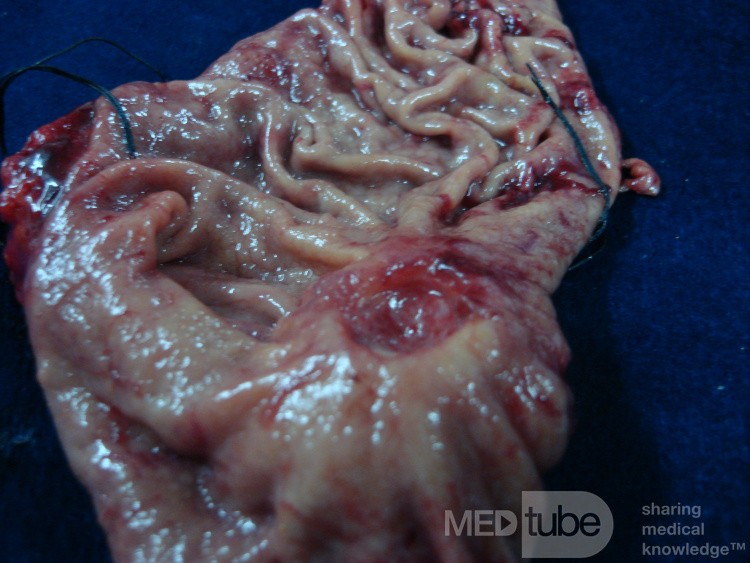 Diffuse Adenocarcinoma with signet ring cells (5 of 18)