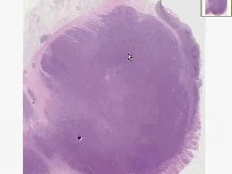 Burkitt lymphoma - Histopathology - Colon