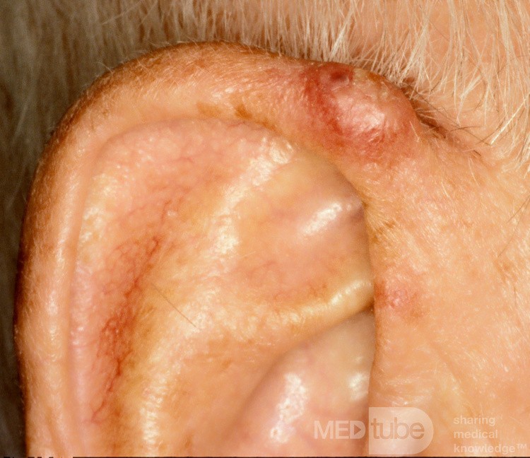 Squamous Cell Carcinoma