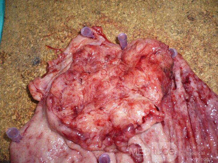 Adenocarcinoma of the cardias and gastric fundus with signet-ring cells (9 of 25)