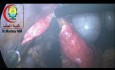 Laparoscopic Deroofing (Fenestrations) of Liver Cyst