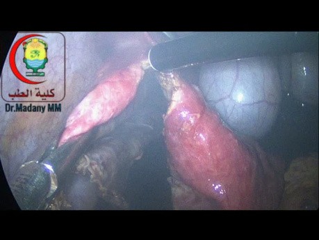 Laparoscopic Deroofing (Fenestrations) of Liver Cyst