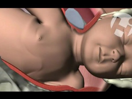 Shoulder Dystocia