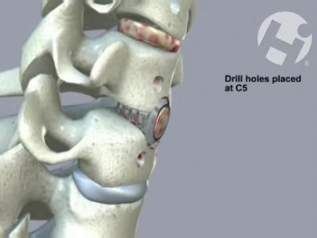 Vertebrectomy, Partial Corpectomy and Wide Canal Decompression