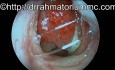 Inflamed Nasopharyngeal Lymphoid Tissue