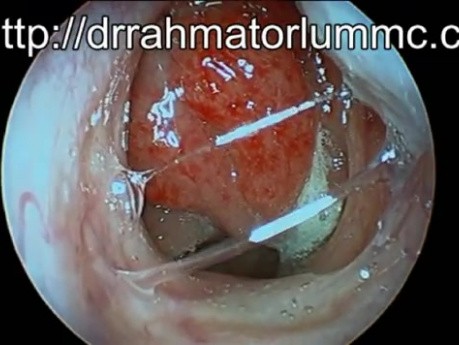 Inflamed Nasopharyngeal Lymphoid Tissue