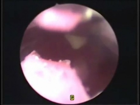 Hysteroscopy of artificial uterus