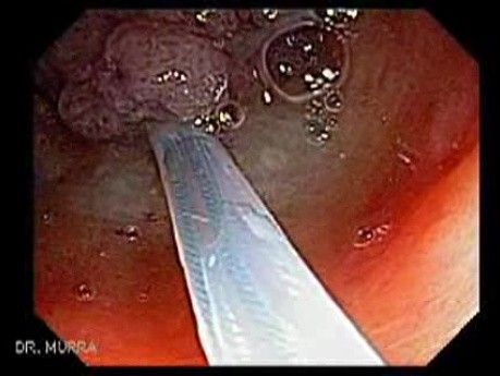 Giant Tubulo - Villous Adenoma (9 of 17)