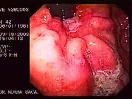 Pseudo Achalasia (3 of 4)