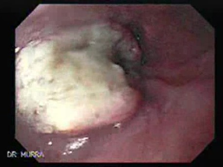 Esophageal Squamous Cell Carcinoma - 72 Year-Old Female