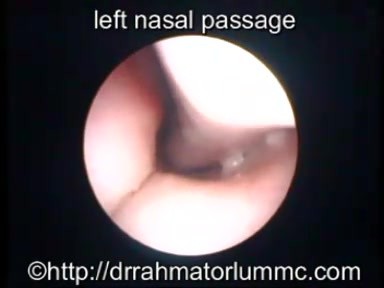 Bilateral Retracted Eardrum with middle ear effusion in a child