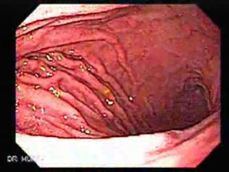 Acute Gastritis (4 of 6)