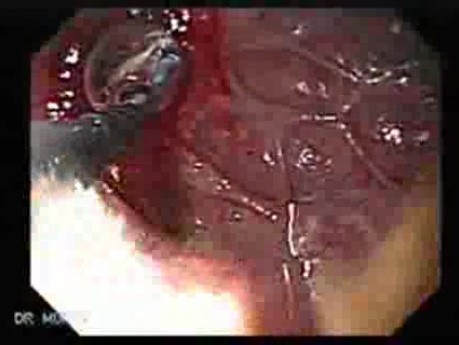 Gastric Cicatrization With Pylorus Stenosis (4 of 23)