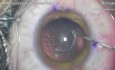 Keratoconus - the use of TORIC ICL