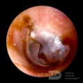 Large Cholesterol Granuloma Middle Ear