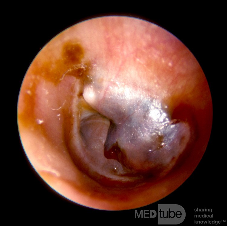Large Cholesterol Granuloma Middle Ear