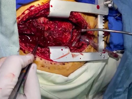 Post Redo Operation Severe RV Dysfunction and Ballooning