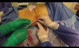 Subcutaneousureteral Ureteral Bypass for Complex Ureteral Stenosis