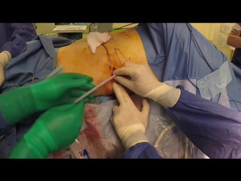 Laparoscopic prostatectomy