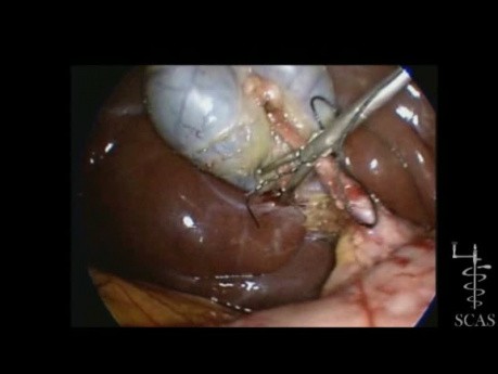 A New Technical Approach for Minilaparoscopic Clipless Cholecystectomy