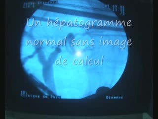 Laparoscopic Cholecystectomy