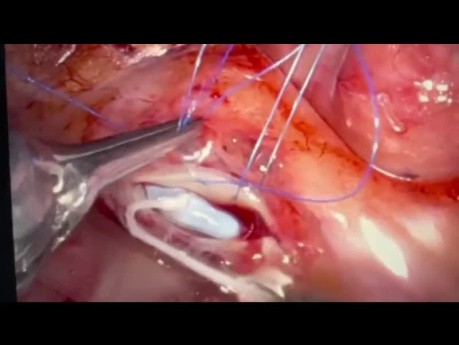  Complete Robotic CABG
