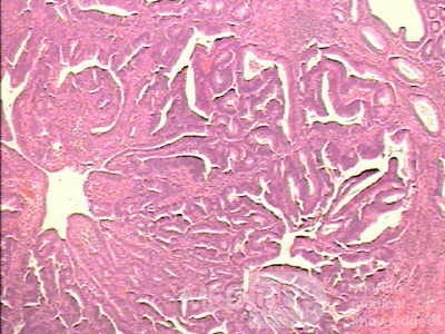 Malign Polyp (4 of 8)