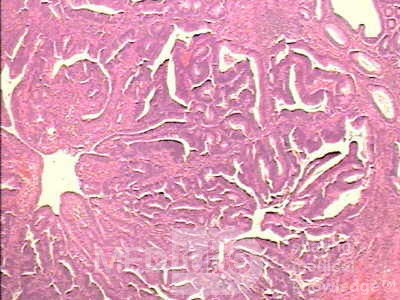 Malign Polyp (4 of 8)