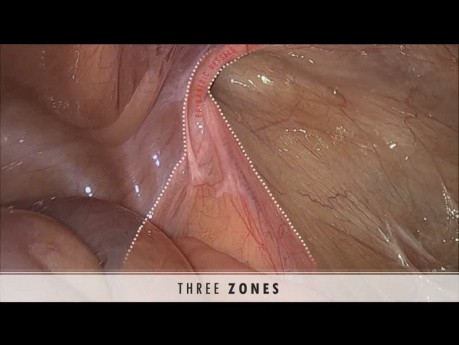 How to Avoid Getting Lost in MIS Hernia Repair? Reversed Y, Three Zones and Five Triangles