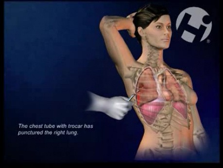 Chest Tube, Mini-thoracotomy, and Right Upper Lobe Wedge Excision