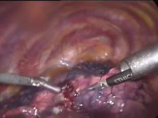 Thoracoscopic lung surgery