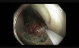 Colonoscopy - Rectum - LST Nongranular Tumor - Piecemeal EMR