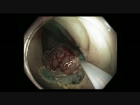 Colonoscopy - Rectum - LST Nongranular Tumor - Piecemeal EMR