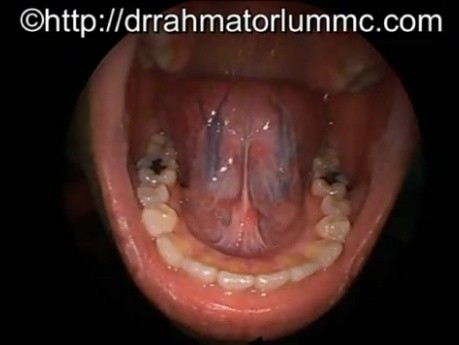 The Human Floor of Mouth and The Tongue Anatomy