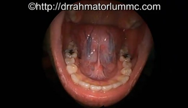 The Human Floor Of Mouth And The Tongue Anatomy Video Medtube Net