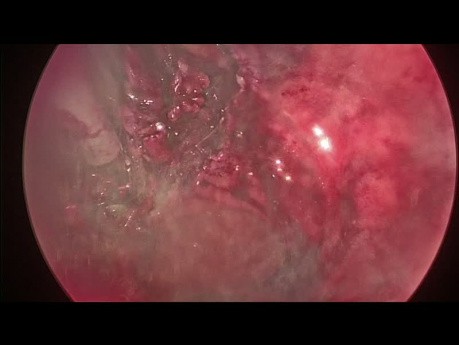 Recurrent Adenocarcinoma of the Upper Rectum (cT1-T2n0)
