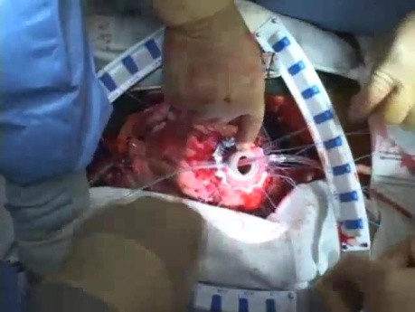 Implantation of a Left Ventricular Assist Device (Heartmate II LVAD)