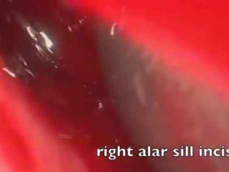 Empty Nose Syndrome - Reconstructive Surgery