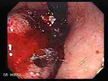 Adenocarcinoma of the Corpus and Fundus (3 of 4)