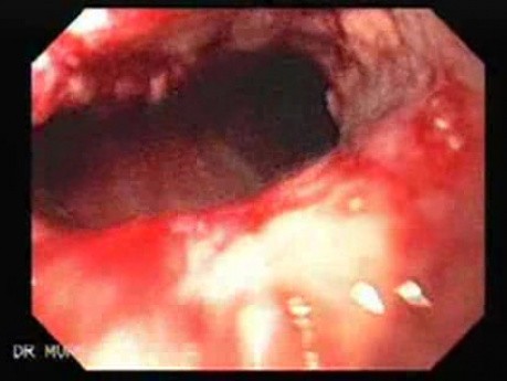 Synchronous Cancer (Gastric and Esophageal) - Endoscopic Image of Esophageal Carcinoma of the Middle Third