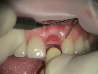 From Extraxtion To Implantation