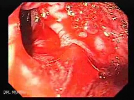 Duodenal Ulcer and Bleeding (19 of 23)